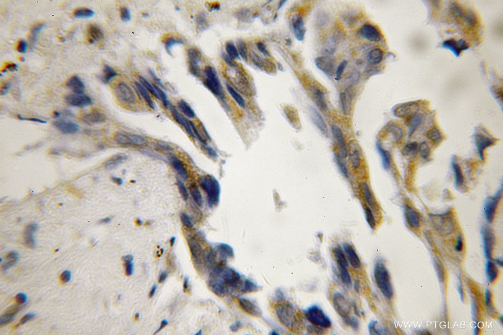 Immunohistochemistry (IHC) staining of human lung cancer tissue using TID1 Polyclonal antibody (11088-1-AP)