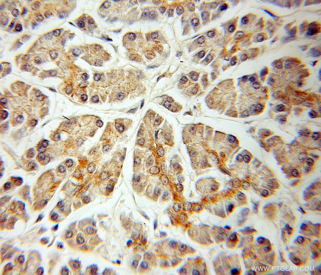 Immunohistochemistry (IHC) staining of human pancreas cancer tissue using TID1 Polyclonal antibody (11088-1-AP)