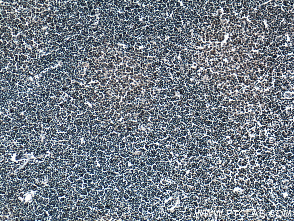 Immunohistochemistry (IHC) staining of human lymphoma tissue using DNAJB1 Polyclonal antibody (13174-1-AP)