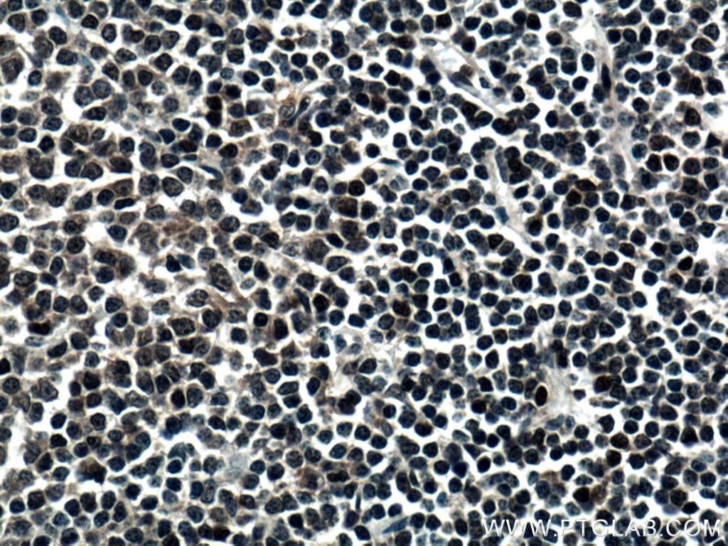 Immunohistochemistry (IHC) staining of human lymphoma tissue using DNAJB1 Polyclonal antibody (13174-1-AP)