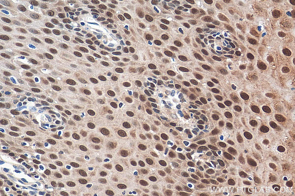 Immunohistochemistry (IHC) staining of human oesophagus cancer tissue using DNAJB1 Polyclonal antibody (13174-1-AP)