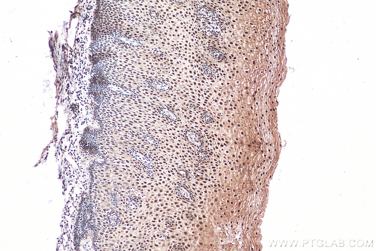 Immunohistochemistry (IHC) staining of human oesophagus cancer tissue using DNAJB1 Polyclonal antibody (13174-1-AP)
