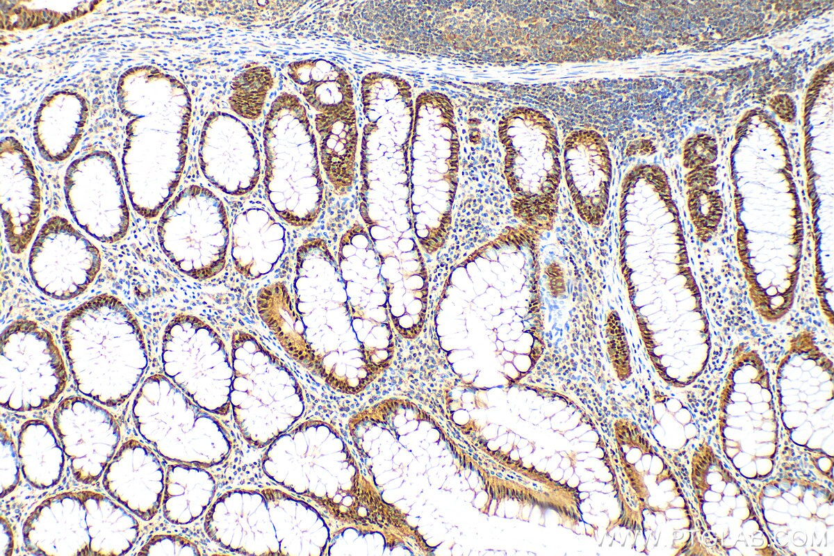 IHC staining of human colon cancer using 82676-1-RR