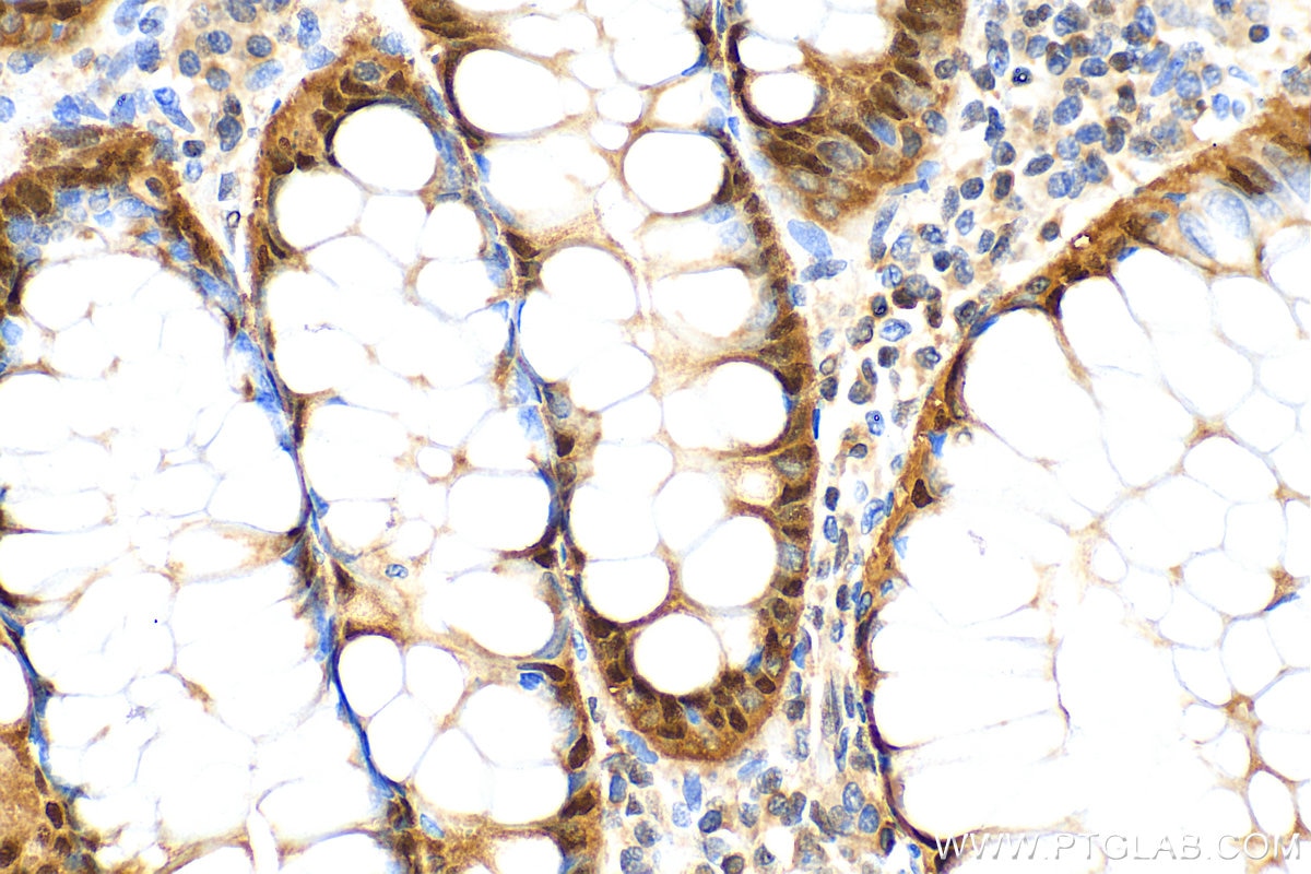 Immunohistochemistry (IHC) staining of human colon cancer tissue using DNAJB1 Recombinant antibody (82676-1-RR)