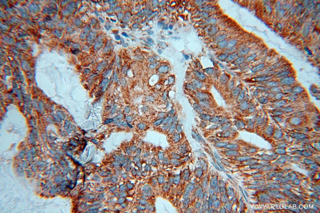 Immunohistochemistry (IHC) staining of human ovary tumor tissue using DNAJB11 Polyclonal antibody (15484-1-AP)