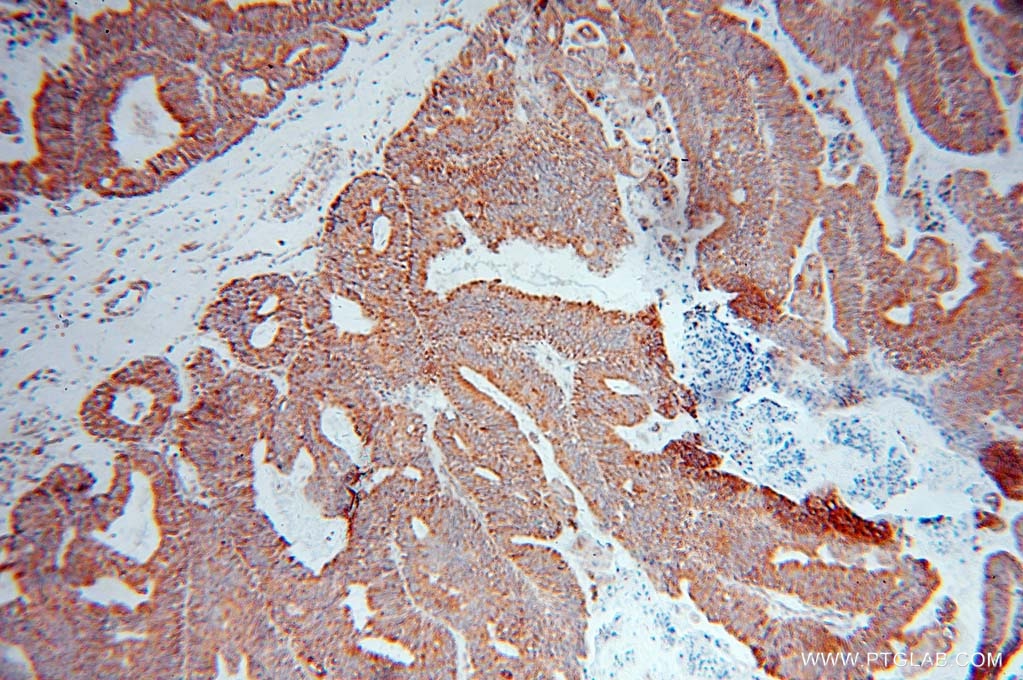 IHC staining of human ovary tumor using 15484-1-AP