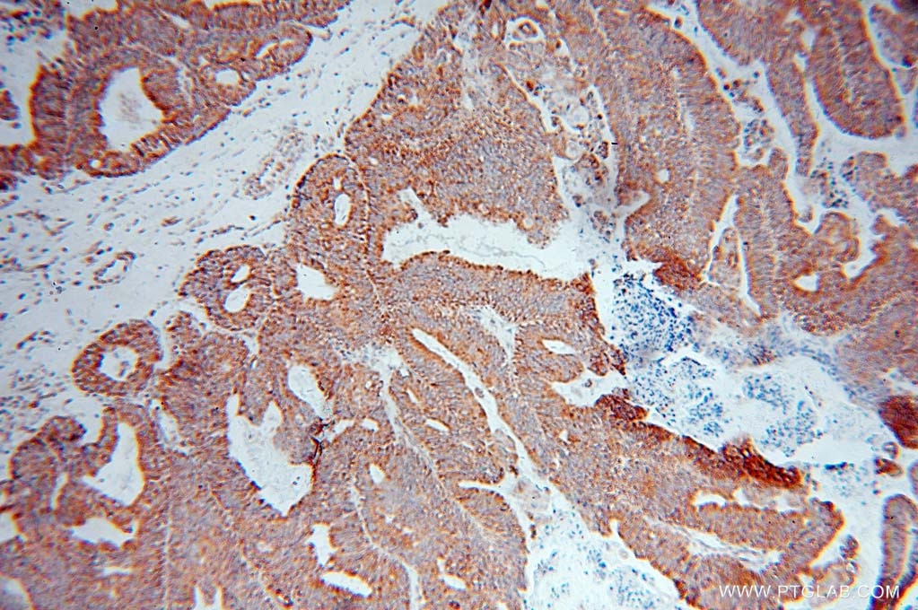 Immunohistochemistry (IHC) staining of human ovary tumor tissue using DNAJB11 Polyclonal antibody (15484-1-AP)