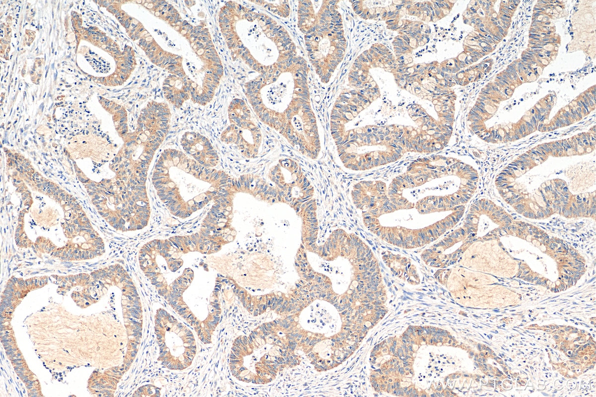 Immunohistochemistry (IHC) staining of human colon cancer tissue using Biotin-conjugated DNAJB12 Polyclonal antibody (Biotin-16780)