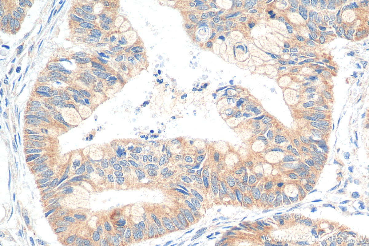 Immunohistochemistry (IHC) staining of human colon cancer tissue using Biotin-conjugated DNAJB12 Polyclonal antibody (Biotin-16780)