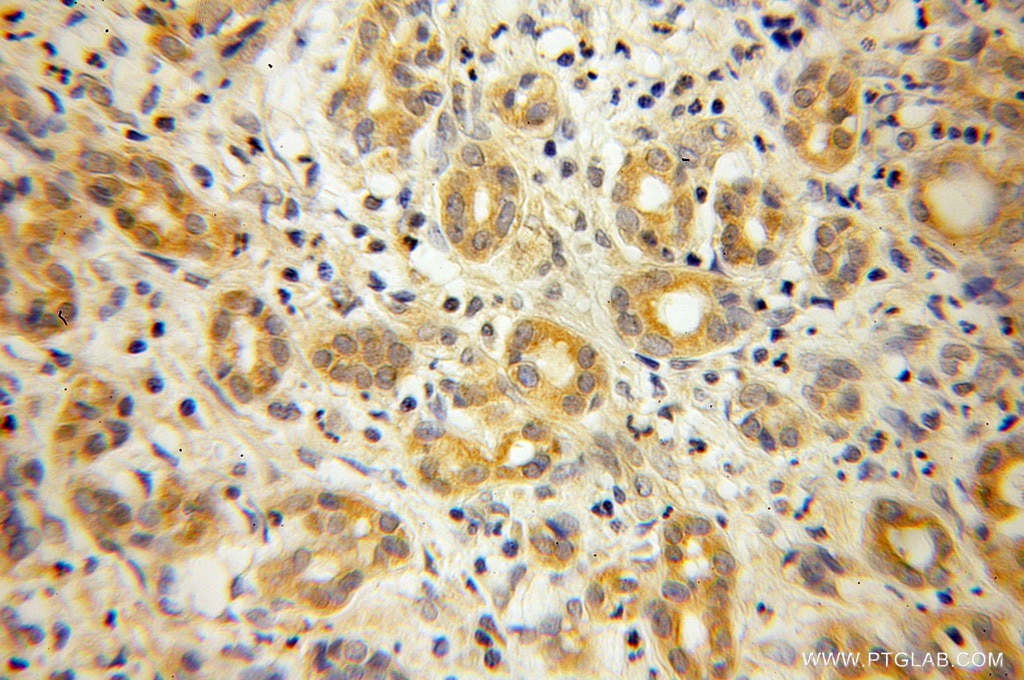 Immunohistochemistry (IHC) staining of human pancreas cancer tissue using DNAJB4 Polyclonal antibody (13064-1-AP)