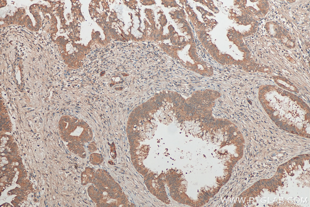 Immunohistochemistry (IHC) staining of human pancreas cancer tissue using DNAJB4 Monoclonal antibody (67966-1-Ig)