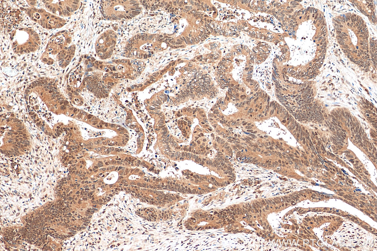 Immunohistochemistry (IHC) staining of human colon cancer tissue using DNAJB6 Polyclonal antibody (11707-1-AP)