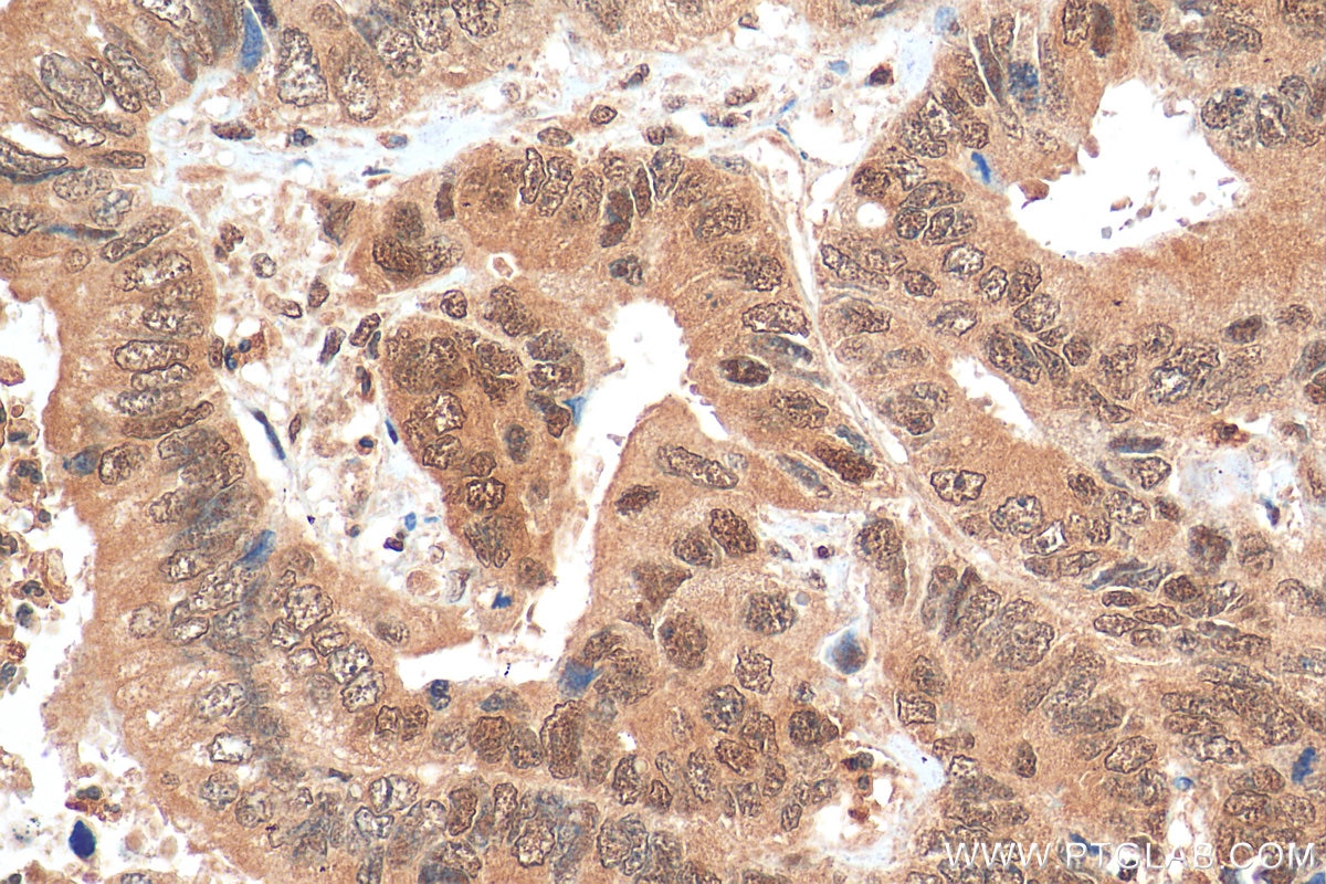 Immunohistochemistry (IHC) staining of human colon cancer tissue using DNAJB6 Polyclonal antibody (11707-1-AP)