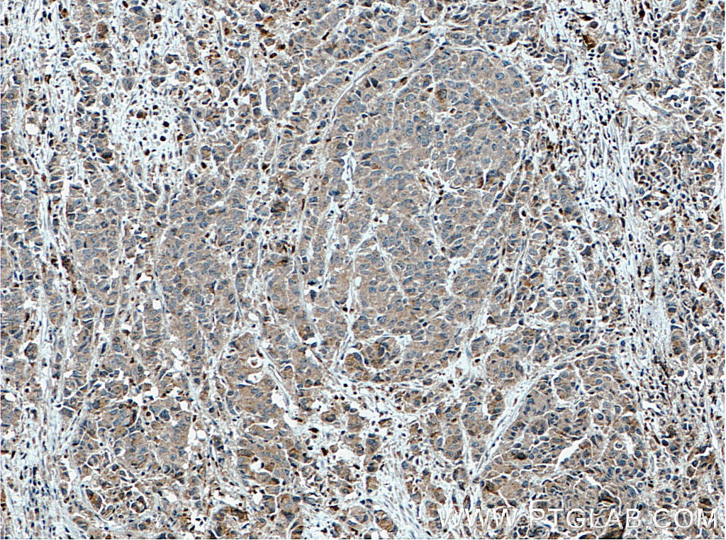 Immunohistochemistry (IHC) staining of human prostate cancer tissue using DNAJB9 Polyclonal antibody (13157-1-AP)