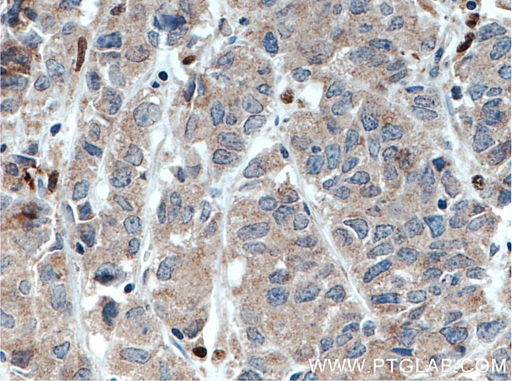 Immunohistochemistry (IHC) staining of human prostate cancer tissue using DNAJB9 Polyclonal antibody (13157-1-AP)
