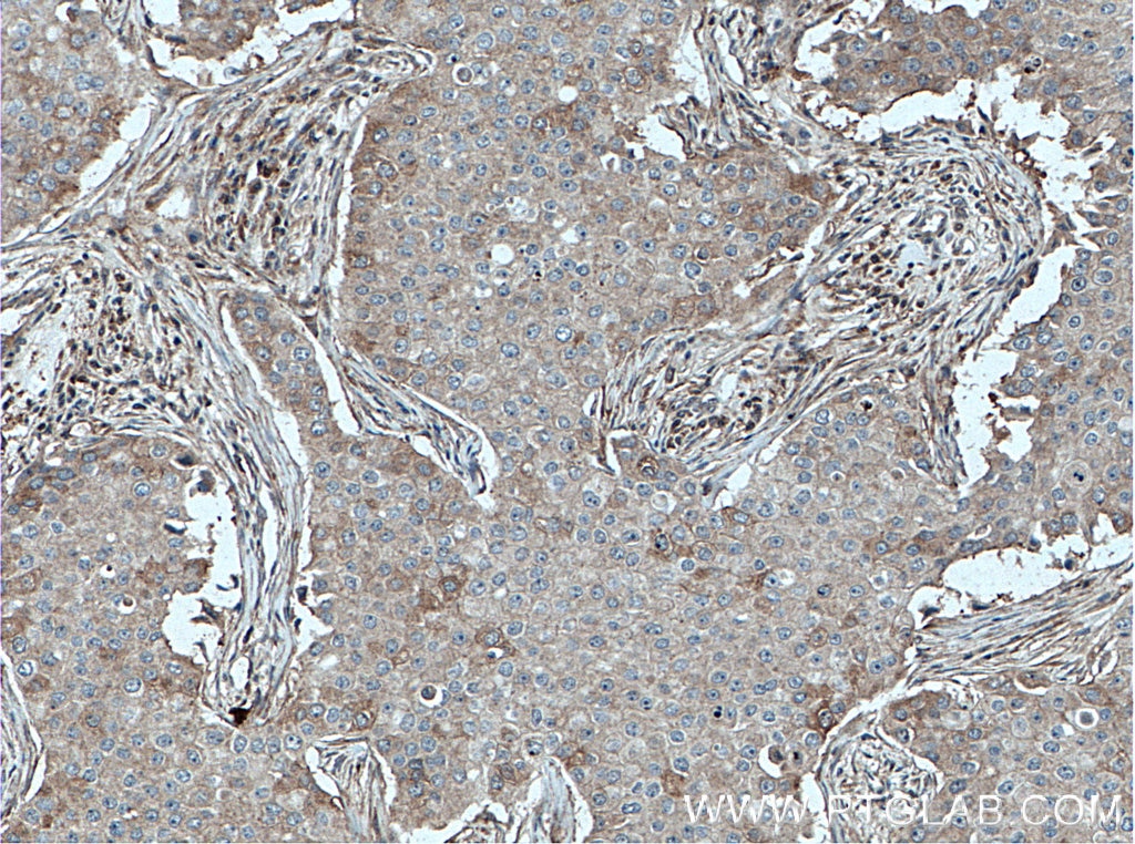 Immunohistochemistry (IHC) staining of human breast cancer tissue using DNAJB9 Polyclonal antibody (13157-1-AP)