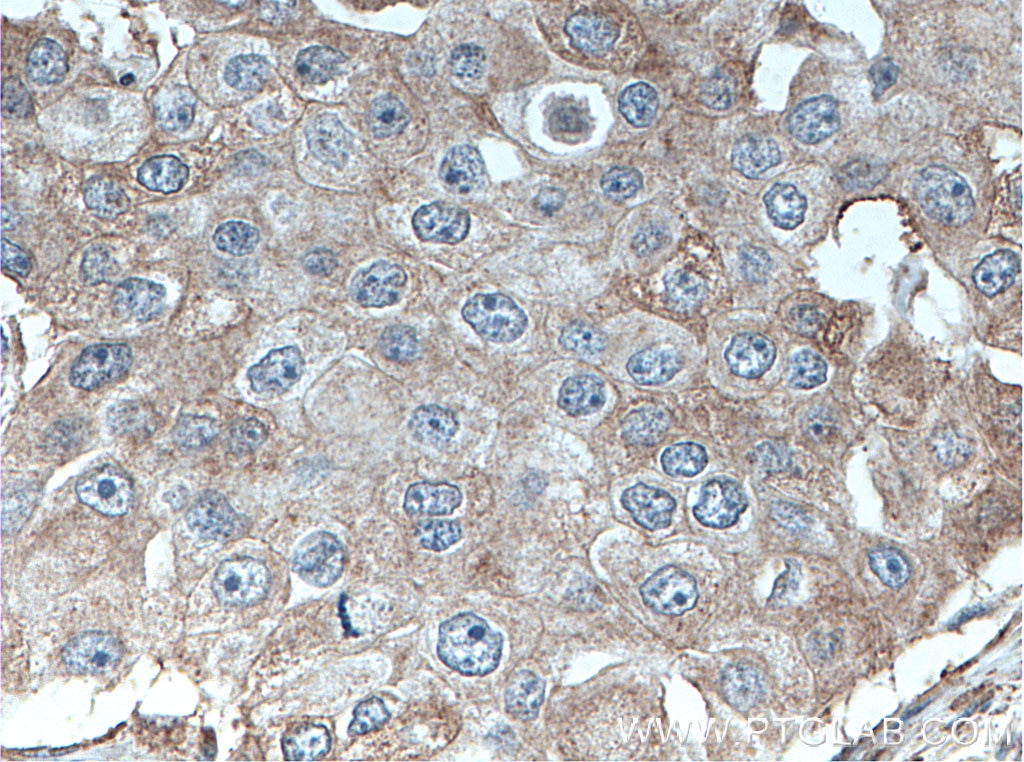 Immunohistochemistry (IHC) staining of human breast cancer tissue using DNAJB9 Polyclonal antibody (13157-1-AP)