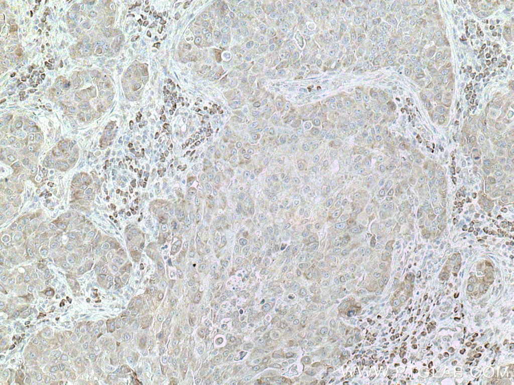 IHC staining of human breast cancer using 12362-1-AP