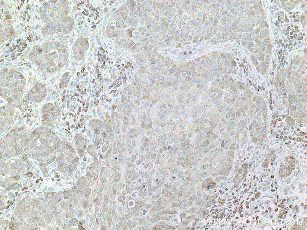 Immunohistochemistry (IHC) staining of human breast cancer tissue using DNAJC1 Polyclonal antibody (12362-1-AP)