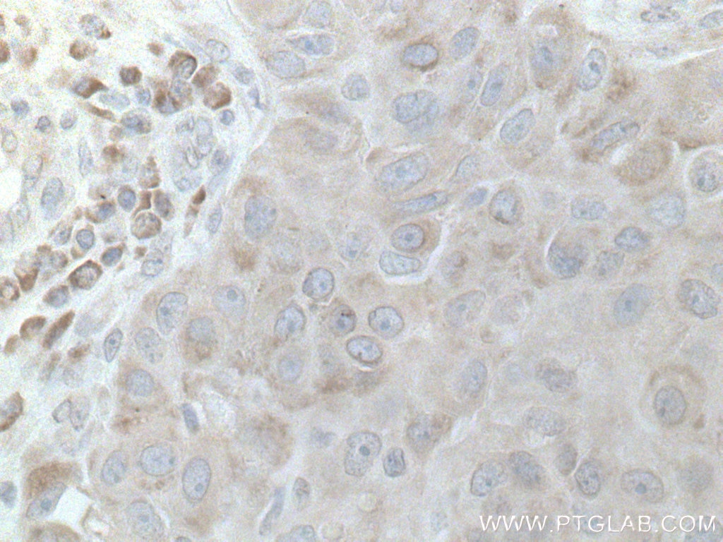 Immunohistochemistry (IHC) staining of human breast cancer tissue using DNAJC1 Polyclonal antibody (12362-1-AP)