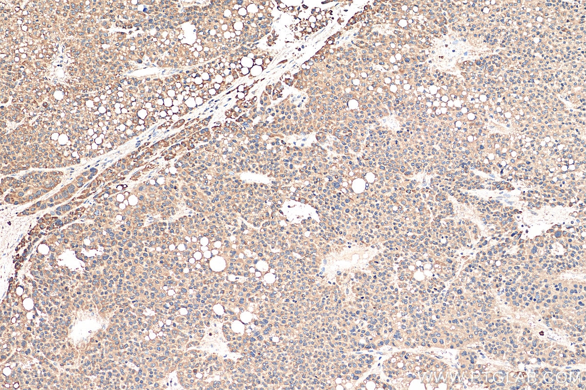 Immunohistochemistry (IHC) staining of human liver cancer tissue using DNAJC1 Polyclonal antibody (12362-1-AP)