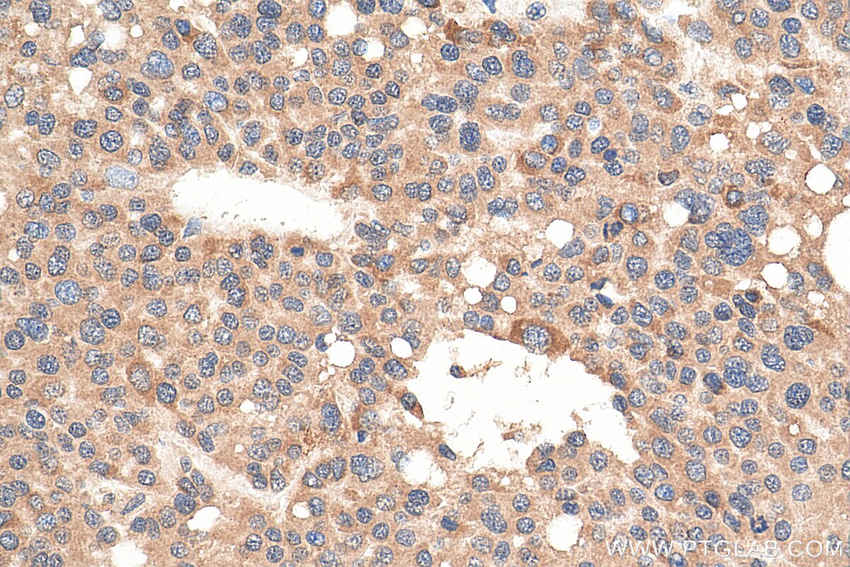 Immunohistochemistry (IHC) staining of human liver cancer tissue using DNAJC1 Polyclonal antibody (12362-1-AP)