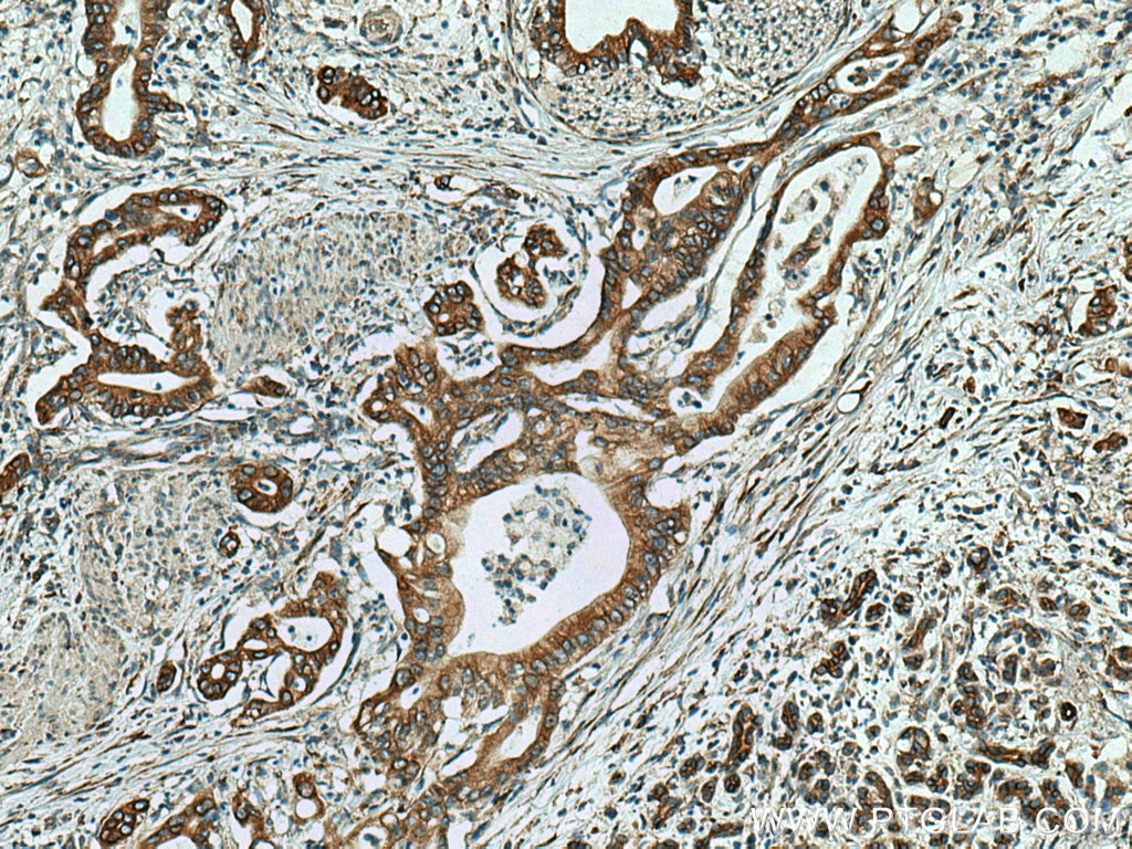 IHC staining of human pancreas cancer using 13101-1-AP