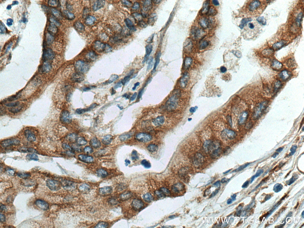 Immunohistochemistry (IHC) staining of human pancreas cancer tissue using DNAJC10 Polyclonal antibody (13101-1-AP)