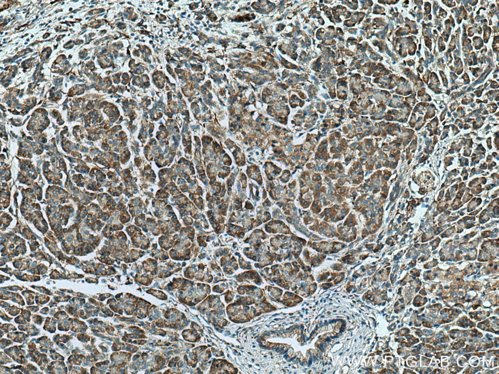 Immunohistochemistry (IHC) staining of human pancreas cancer tissue using DNAJC10 Polyclonal antibody (13101-1-AP)