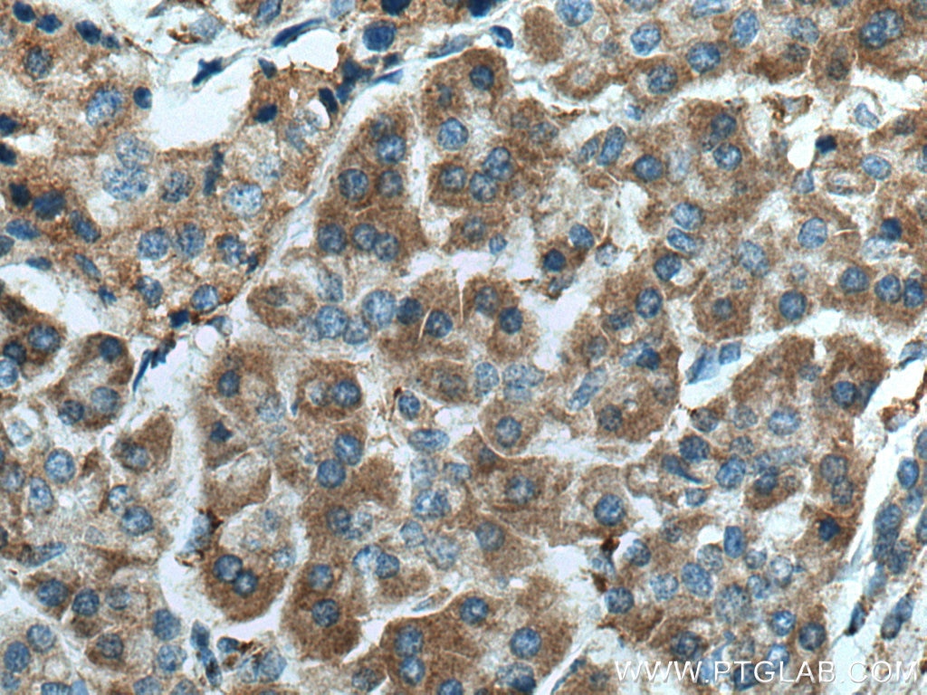 Immunohistochemistry (IHC) staining of human pancreas cancer tissue using DNAJC10 Polyclonal antibody (13101-1-AP)