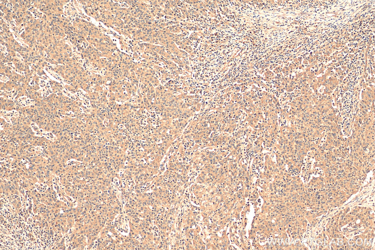 Immunohistochemistry (IHC) staining of human stomach cancer tissue using DNAJC12 Polyclonal antibody (12338-1-AP)
