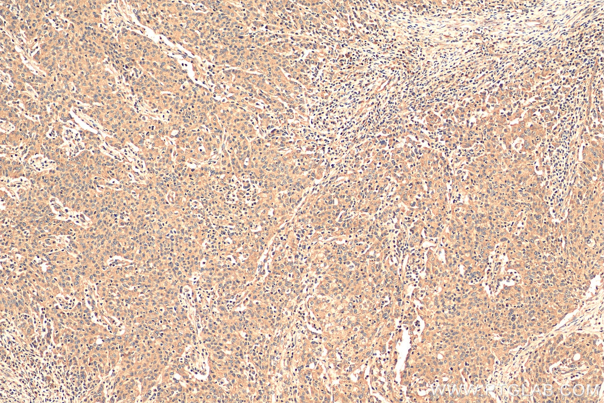 IHC staining of human stomach cancer using 12338-1-AP