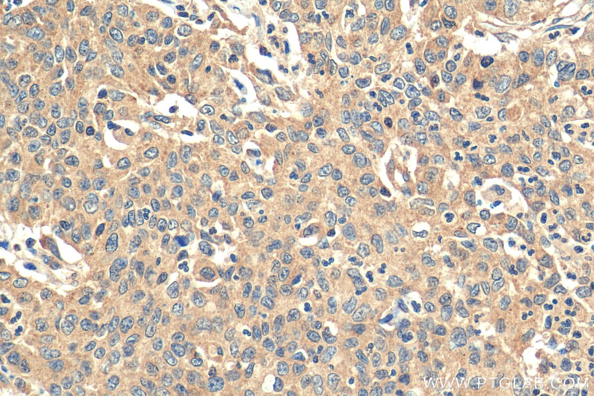 Immunohistochemistry (IHC) staining of human stomach cancer tissue using DNAJC12 Polyclonal antibody (12338-1-AP)