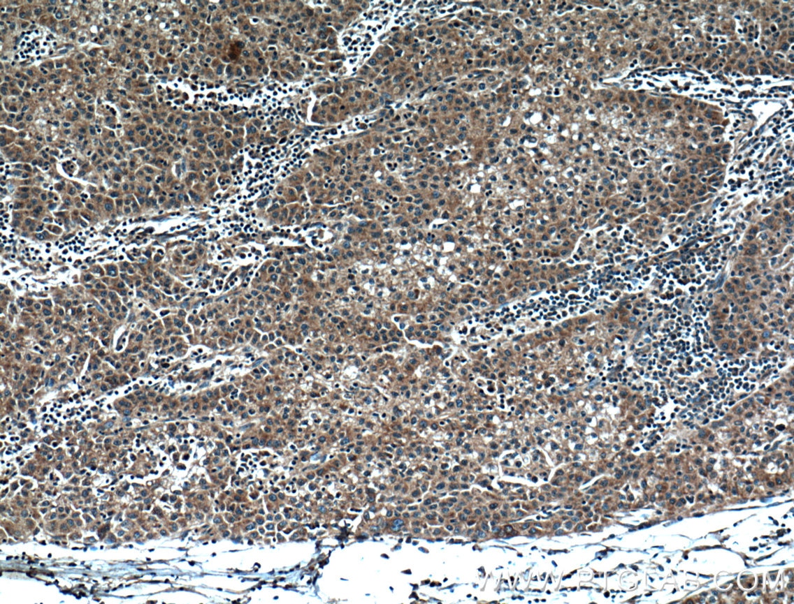 Immunohistochemistry (IHC) staining of human liver cancer tissue using DNAJC2/MPP11 Polyclonal antibody (11971-1-AP)