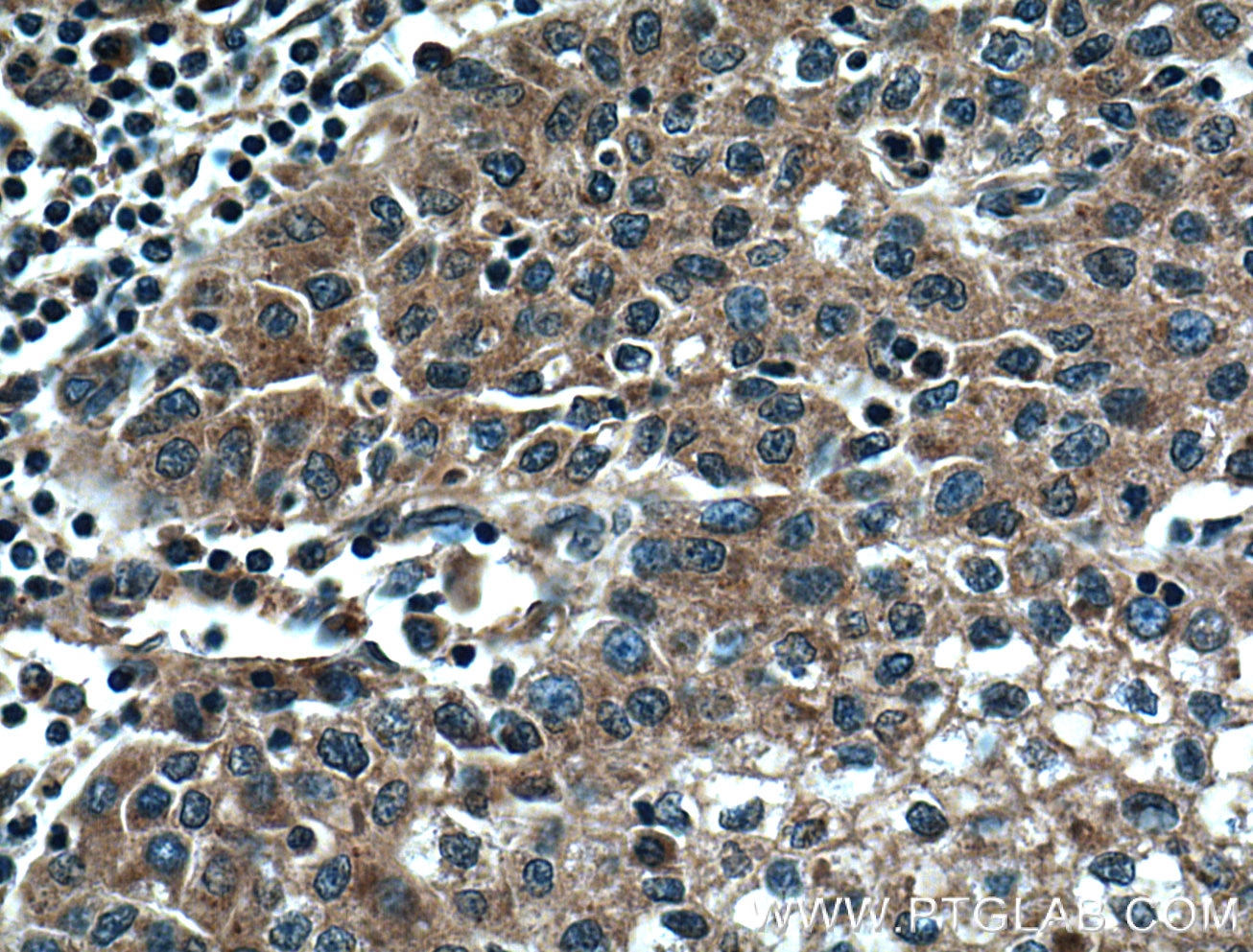 Immunohistochemistry (IHC) staining of human liver cancer tissue using DNAJC2/MPP11 Polyclonal antibody (11971-1-AP)