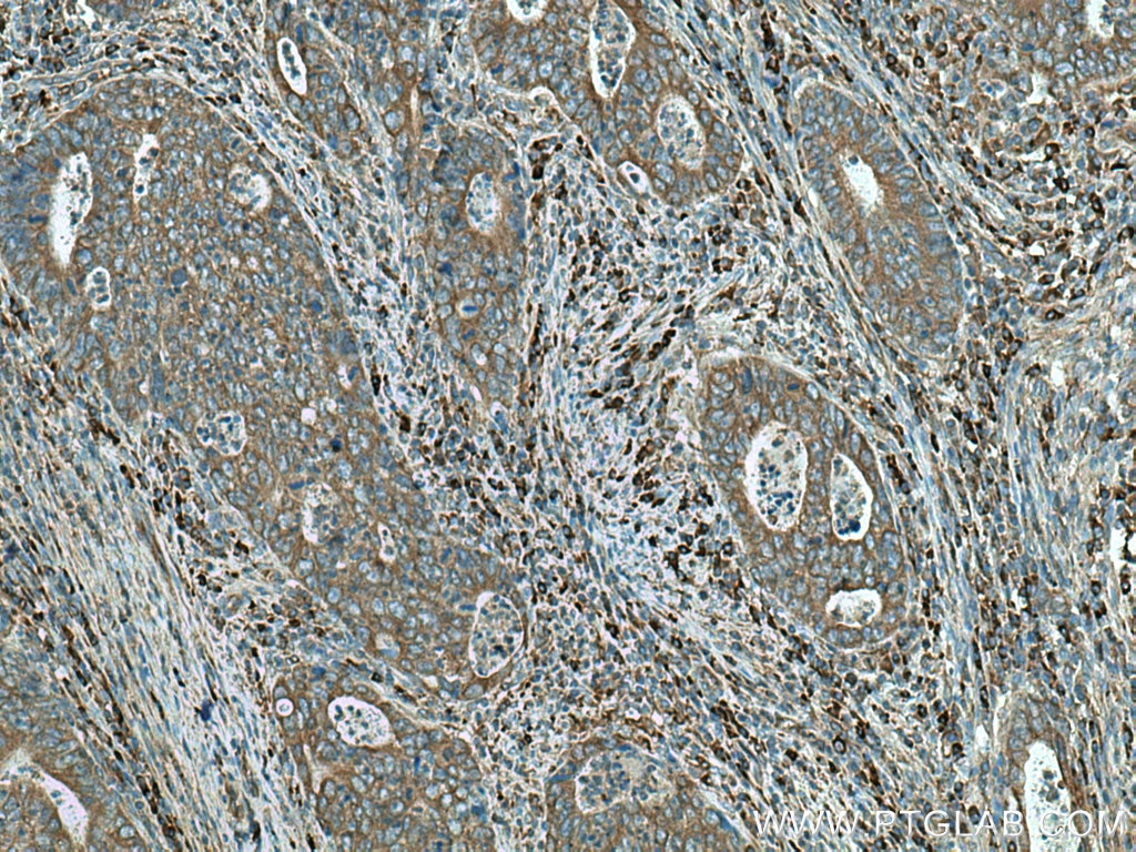 Immunohistochemistry (IHC) staining of human colon cancer tissue using DNAJC3 Polyclonal antibody (26721-1-AP)