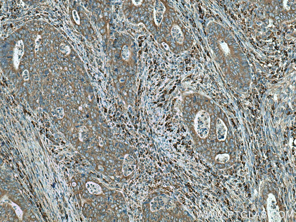 IHC staining of human colon cancer using 26721-1-AP