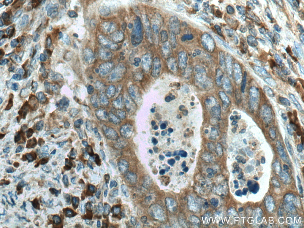 Immunohistochemistry (IHC) staining of human colon cancer tissue using DNAJC3 Polyclonal antibody (26721-1-AP)