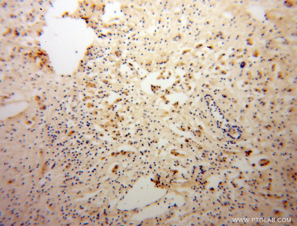 Immunohistochemistry (IHC) staining of human breast cancer tissue using DNAJC4 Polyclonal antibody (13853-1-AP)