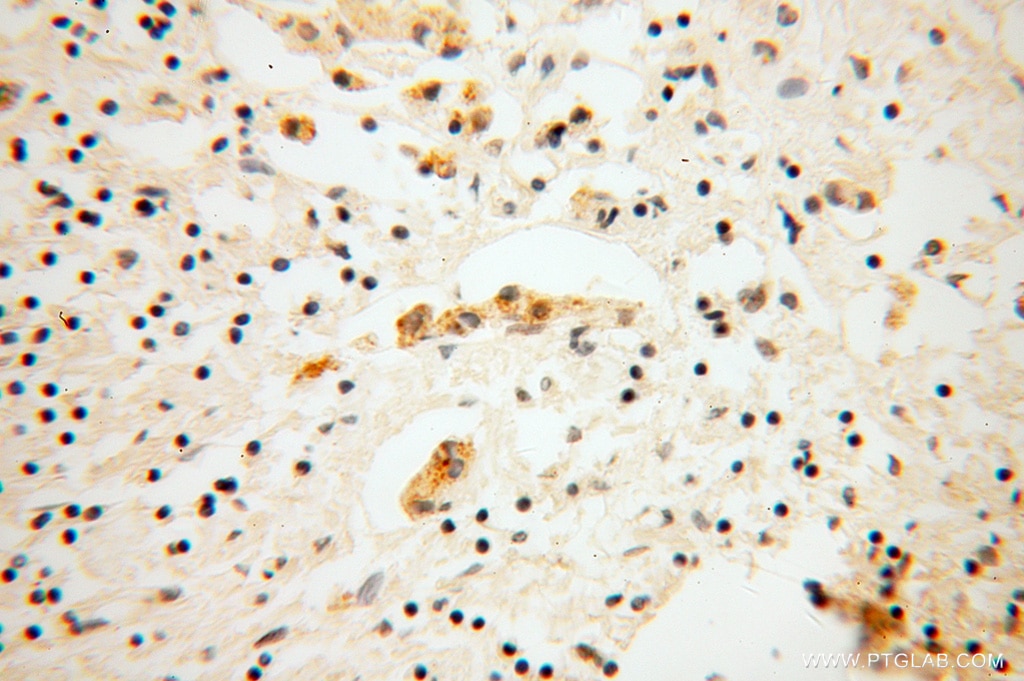 Immunohistochemistry (IHC) staining of human breast cancer tissue using DNAJC4 Polyclonal antibody (13853-1-AP)