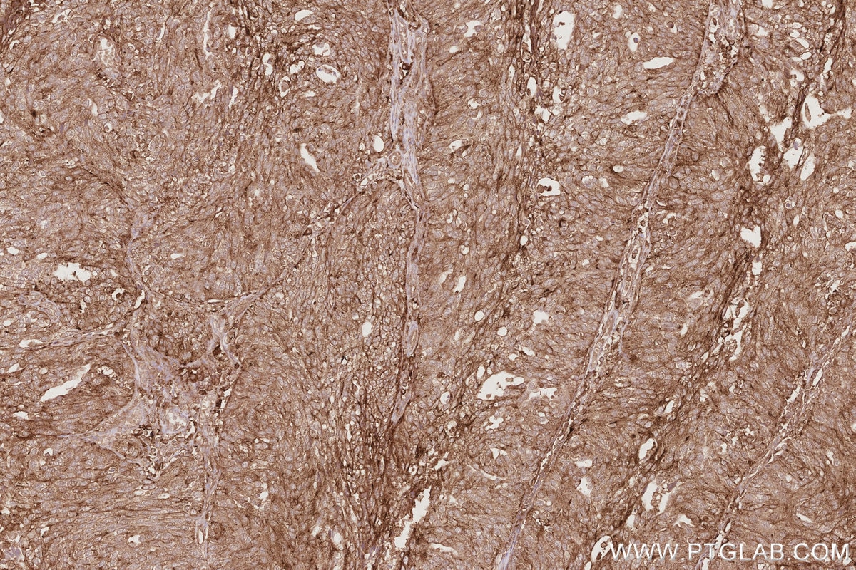 IHC staining of human ovary cancer using 32204-1-AP Immunohistochemistry (IHC) staining of human ovary cancer tissue using DNAJC5 Polyclonal antibody (32204-1-AP)