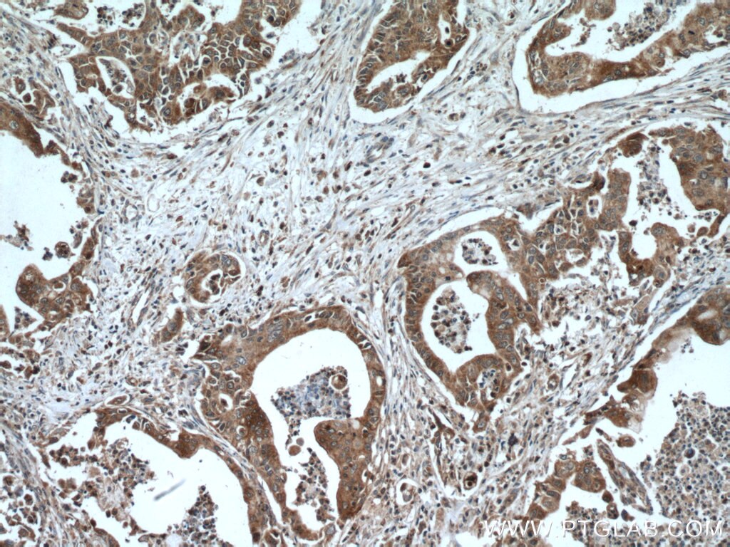 Immunohistochemistry (IHC) staining of human pancreas cancer tissue using DNAJC7 Polyclonal antibody (11090-1-AP)