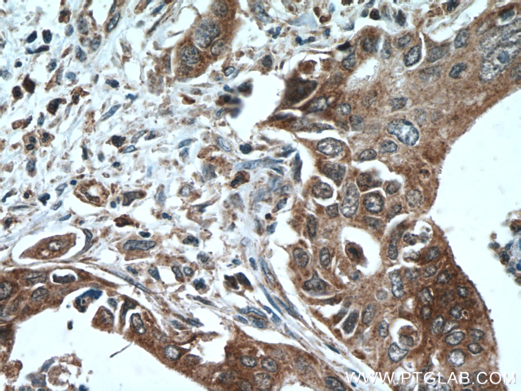 IHC staining of human pancreas cancer using 11090-1-AP