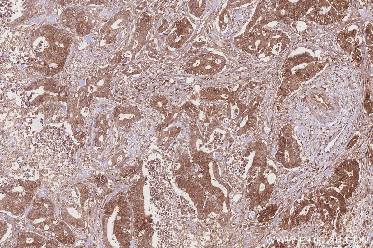 Immunohistochemistry (IHC) staining of human rectal cancer tissue using DNAJC7 Polyclonal antibody (11090-1-AP)