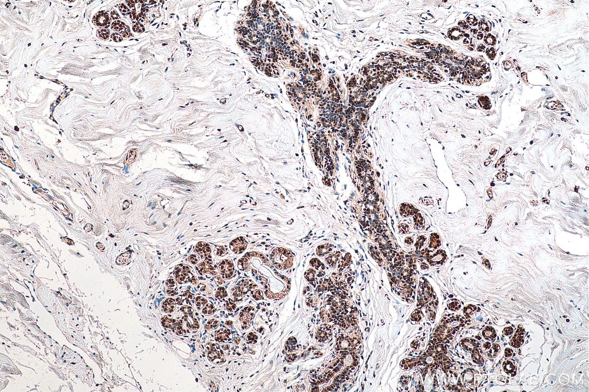 Immunohistochemistry (IHC) staining of human breast cancer tissue using DNAJC9 Polyclonal antibody (25444-1-AP)