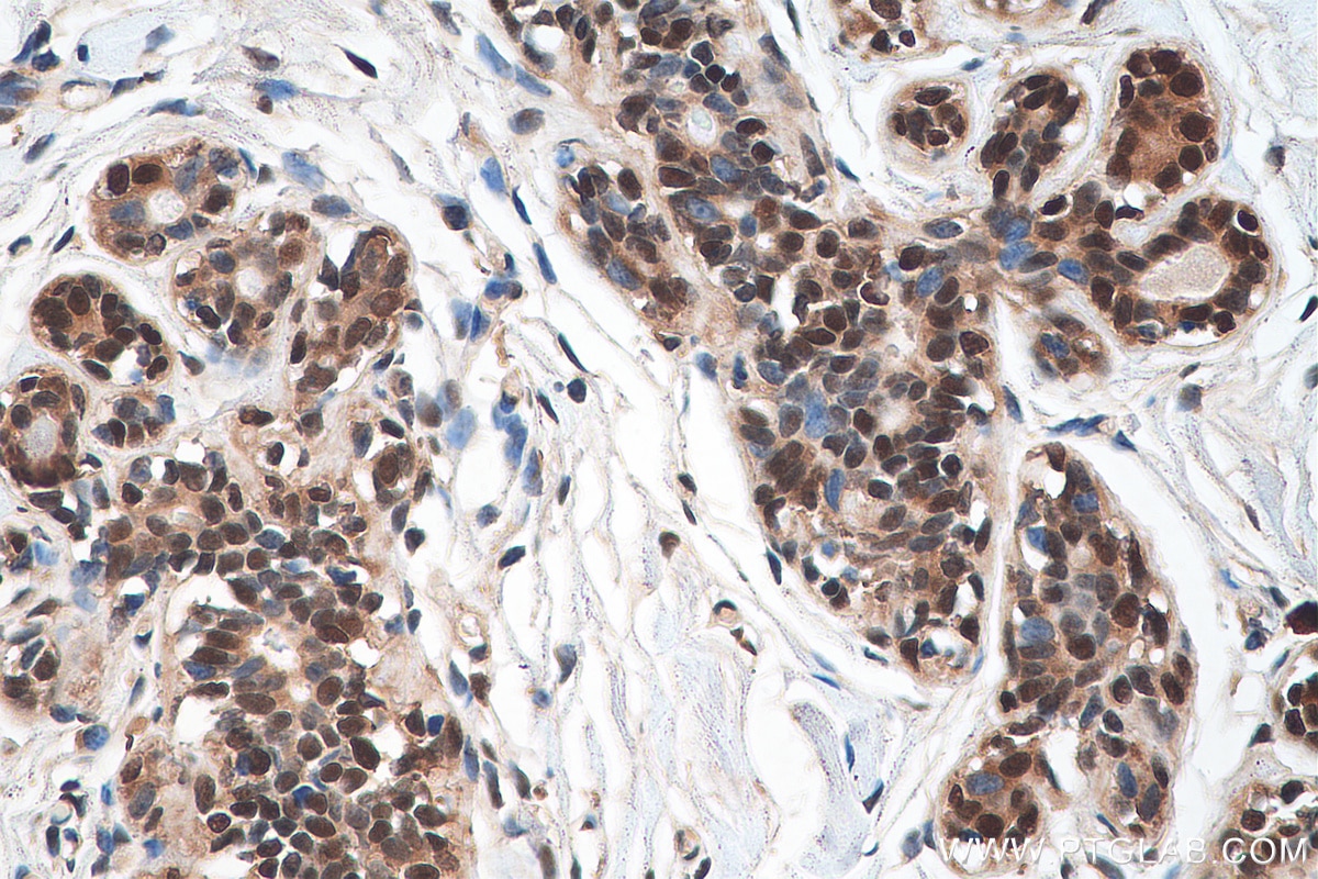 Immunohistochemistry (IHC) staining of human breast cancer tissue using DNAJC9 Polyclonal antibody (25444-1-AP)