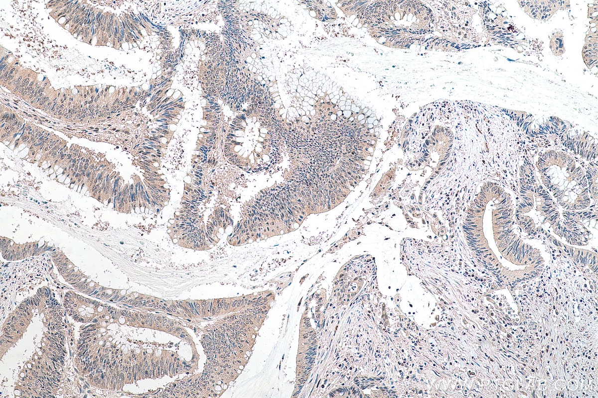 Immunohistochemistry (IHC) staining of human colon cancer tissue using DNAJC9 Polyclonal antibody (25444-1-AP)
