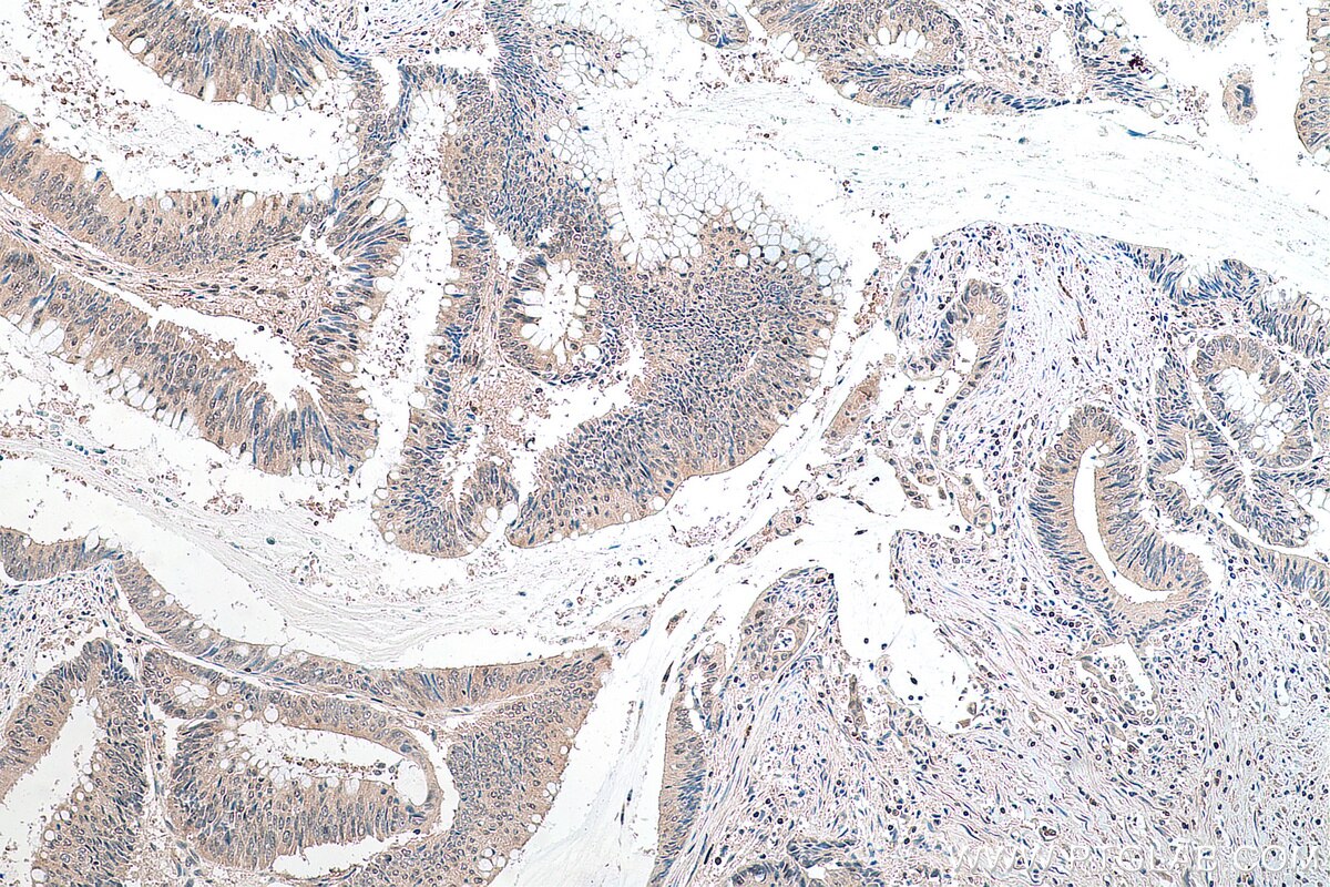 Immunohistochemistry (IHC) staining of human colon cancer tissue using DNAJC9 Polyclonal antibody (25444-1-AP)
