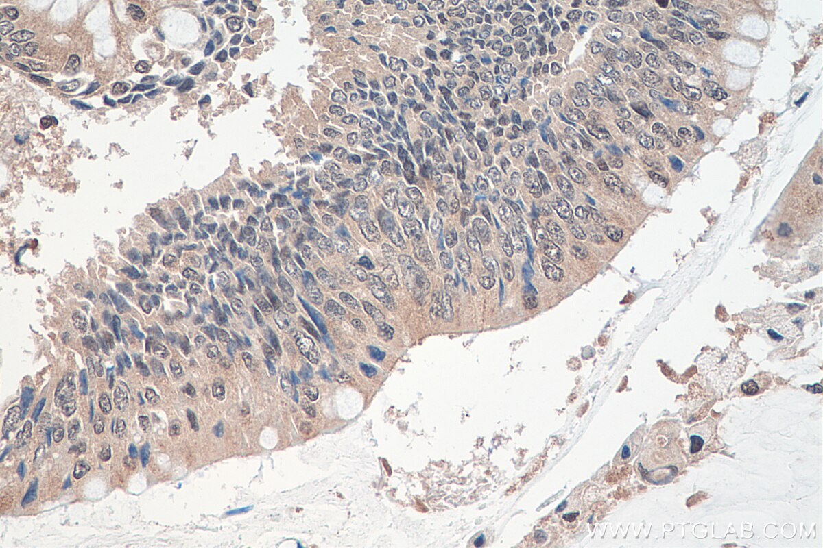 IHC staining of human colon cancer using 25444-1-AP