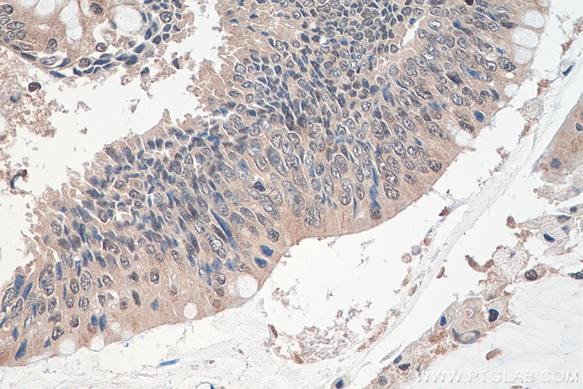 Immunohistochemistry (IHC) staining of human colon cancer tissue using DNAJC9 Polyclonal antibody (25444-1-AP)